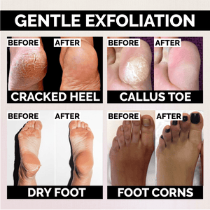 Anti-fungal Exfoliating Foot Soak